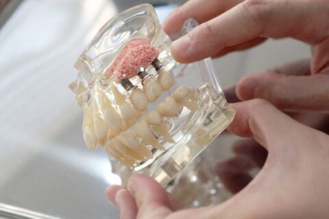 Dental,Tooth,Models,,Implants,,Maxillary,Sinus,Lift,,Bone,Grafting,,Educational