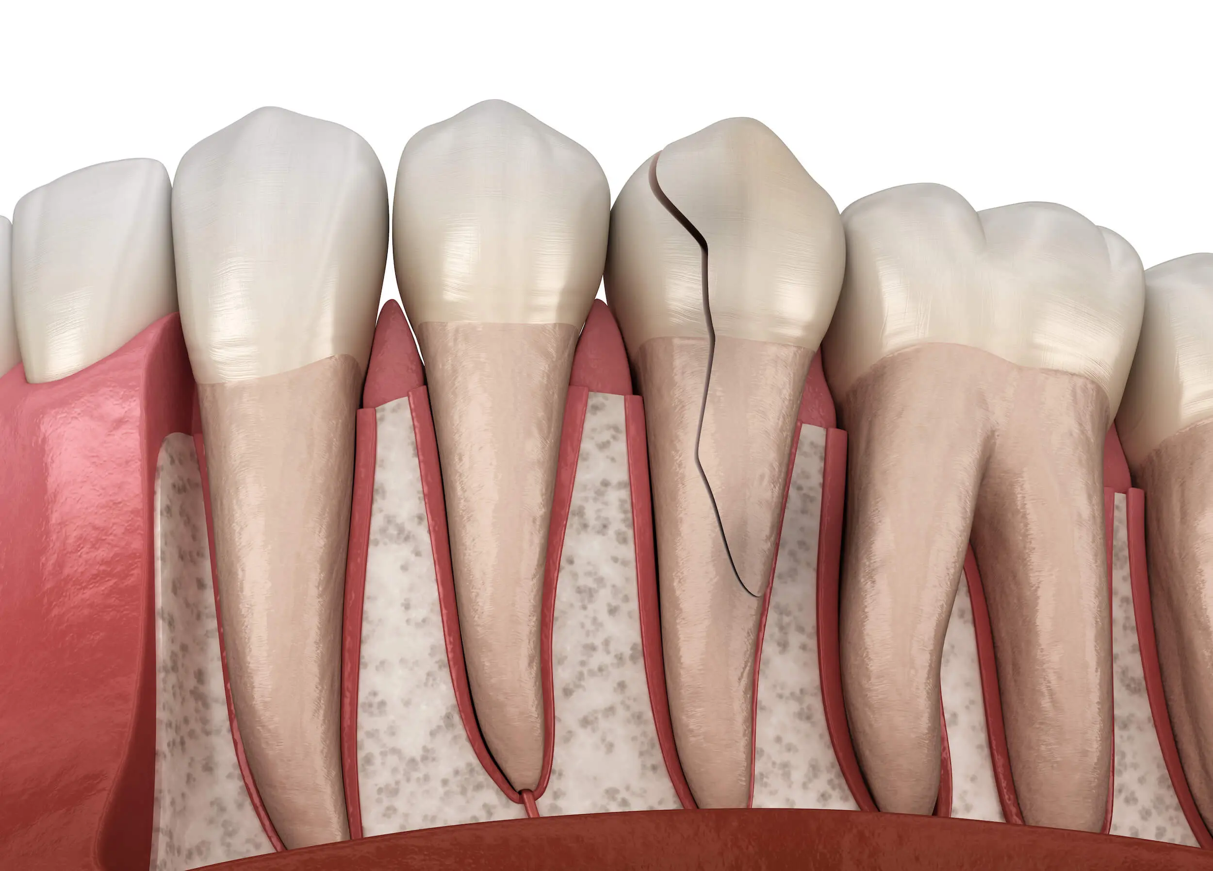 Professional vs. Store-Bought Teeth Whitening