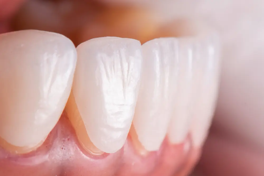 How Long Do Porcelain Veneers Last?