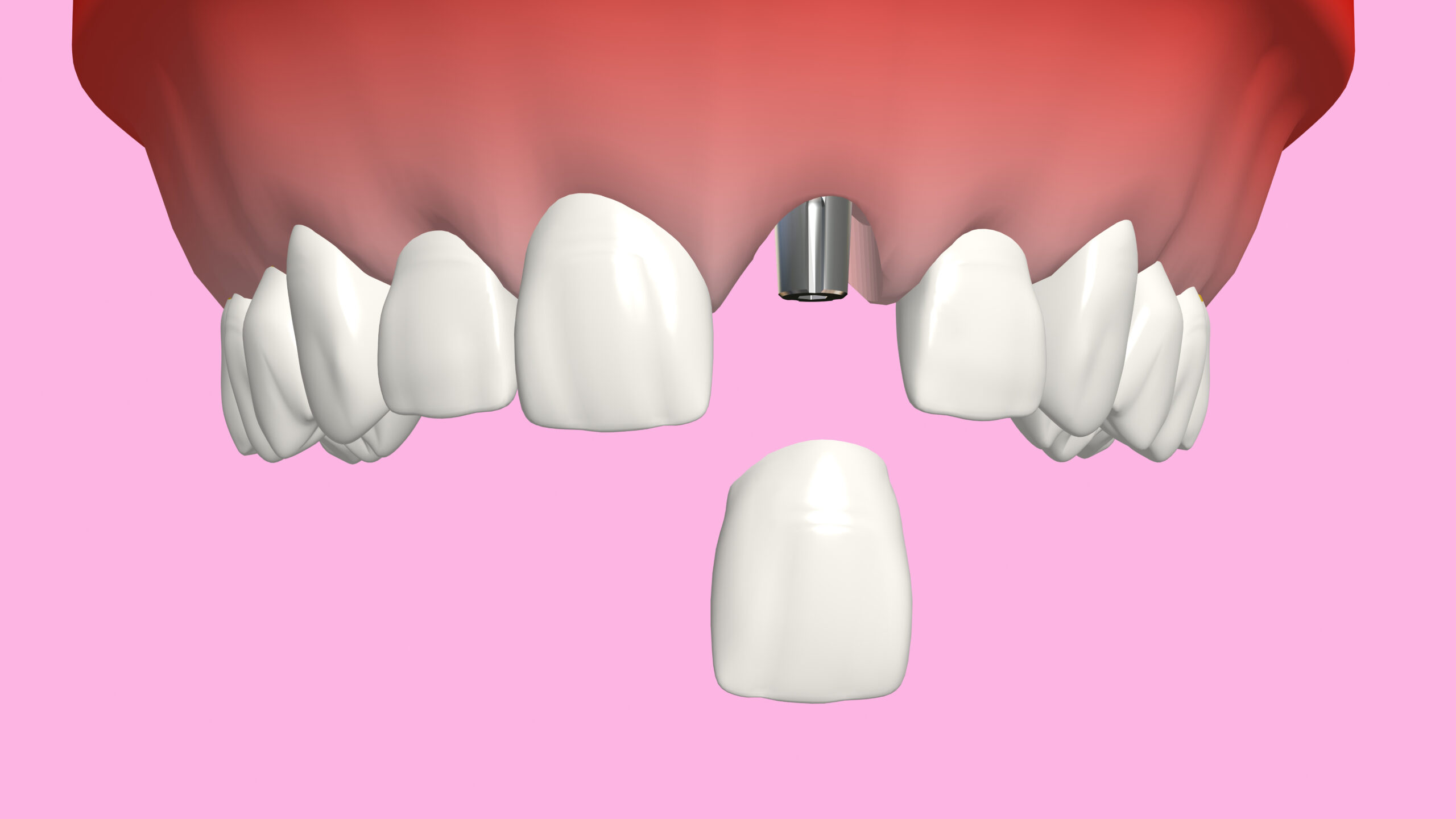 Are You A Candidate For Dental Implants?