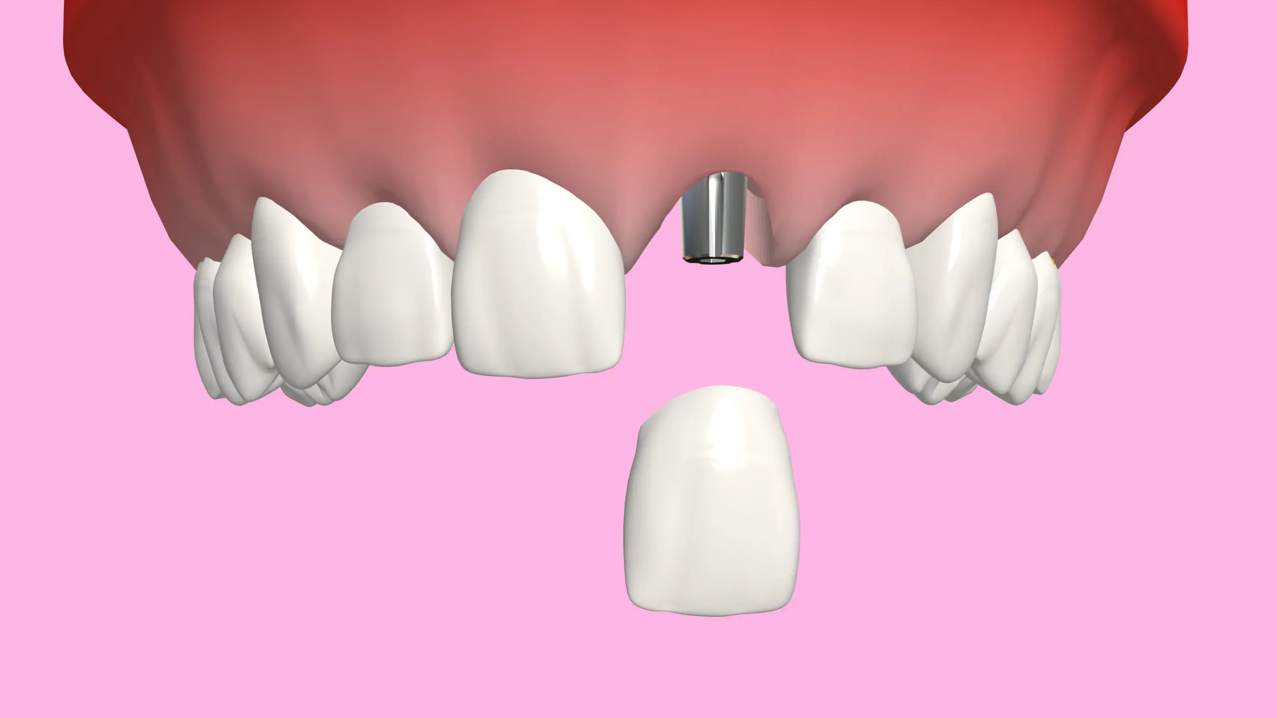 How to Fix a Gummy Smile