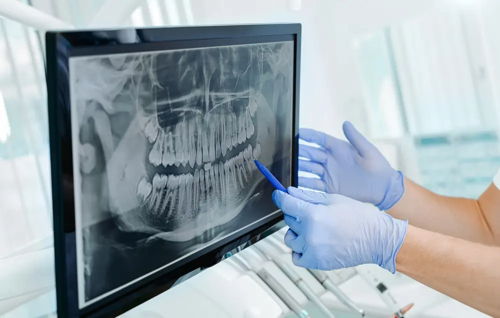 How to Whiten Your Teeth Before a Big Event