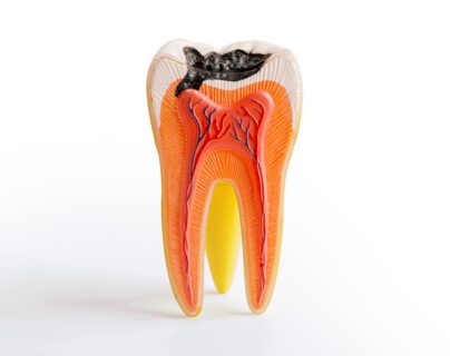 tooth model with cavity