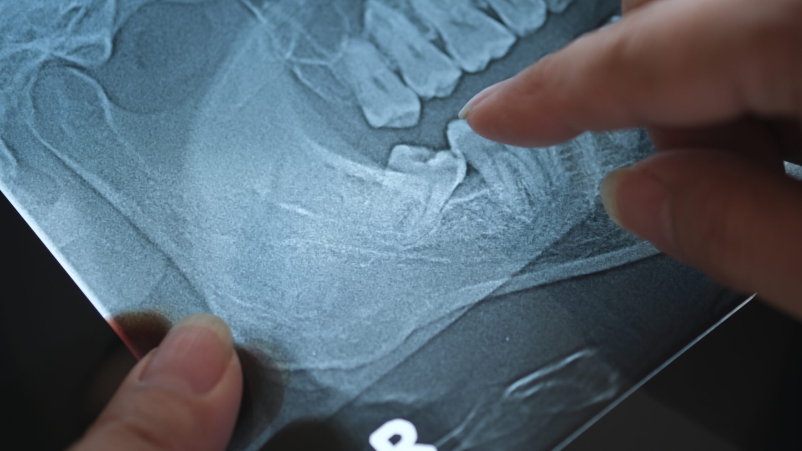 Why You Shouldn’t Wait Too Long To Remove Wisdom Teeth