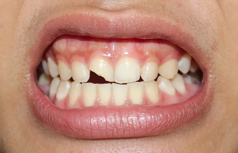 TMJ and Jaw Pain: When to See a Dentist