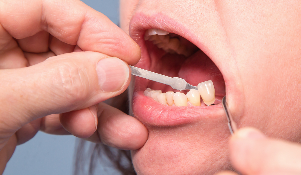 Preparing For Dental Implant Procedures