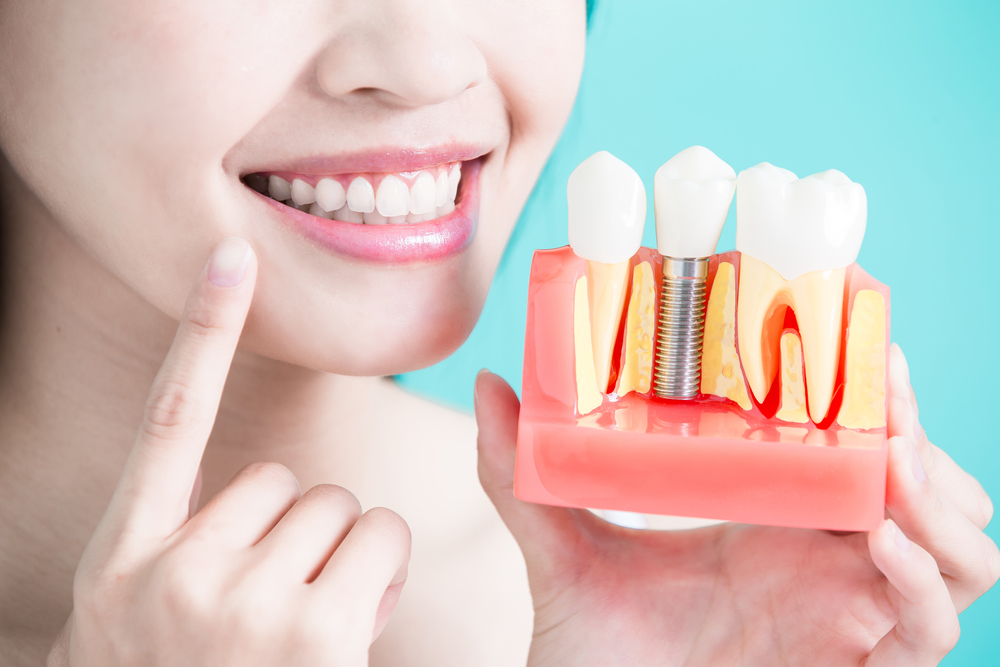 Restoring Teeth With Novadontics Implants