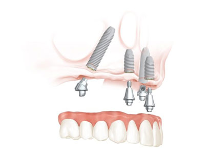 Can Your Tooth Repair Itself?  Infinite Dental Wellness in Glendale, CA